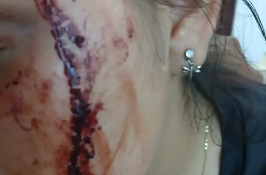  Motochorros asaltan y lesionan a una joven en Pedro Juan Caballero