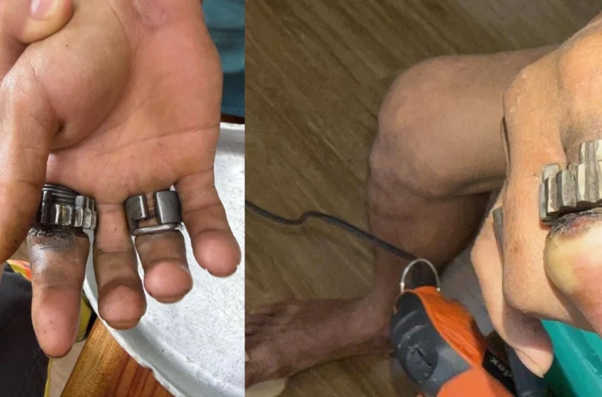  Usó piezas de moto como anillo y casi perdió sus dedos